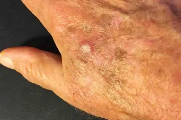 CryoPen for Actinic Keratoses 1 Image of Actinic keratoses Christchurch on a person hand